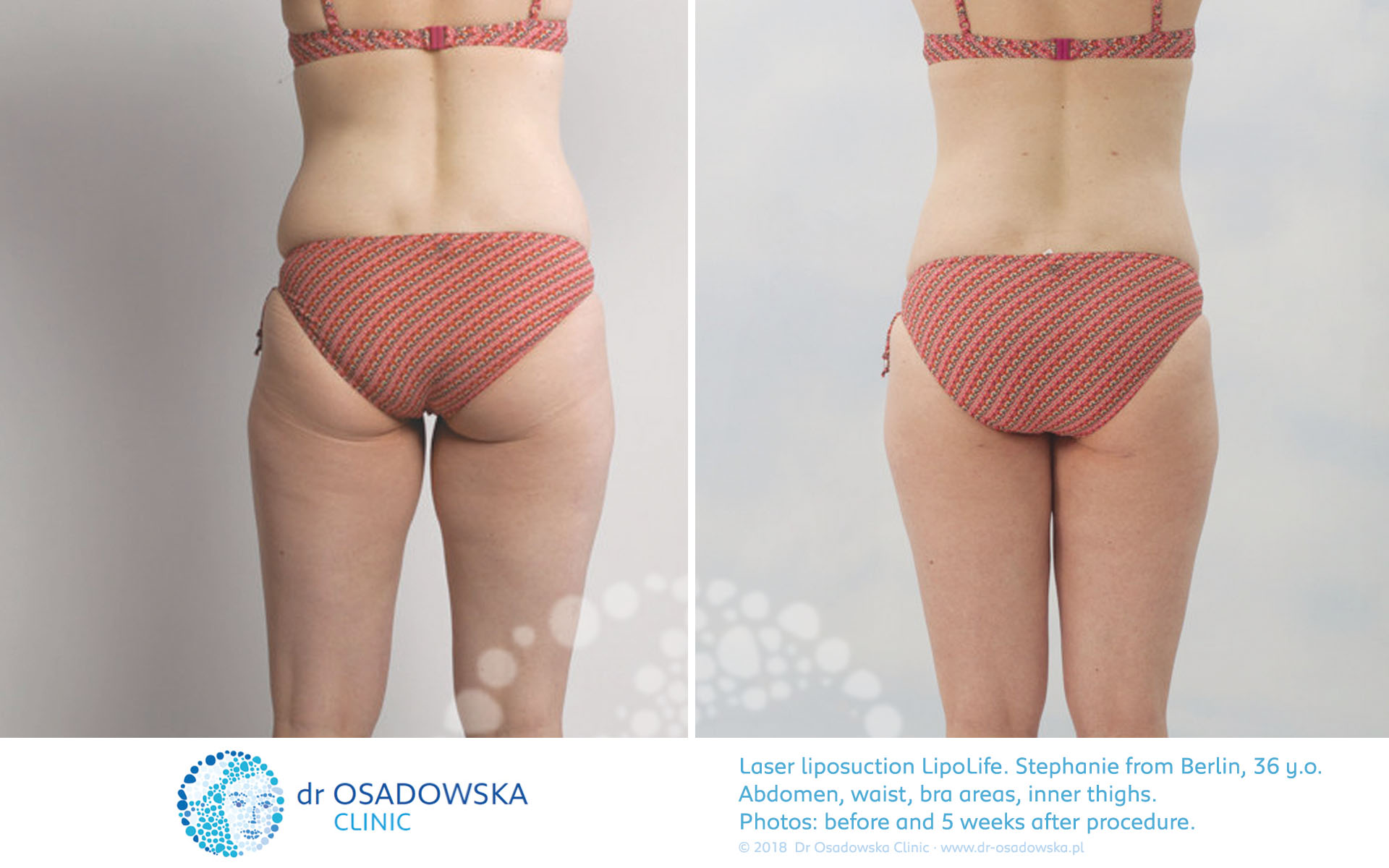 Liposukcja biodra przed po LipoLife