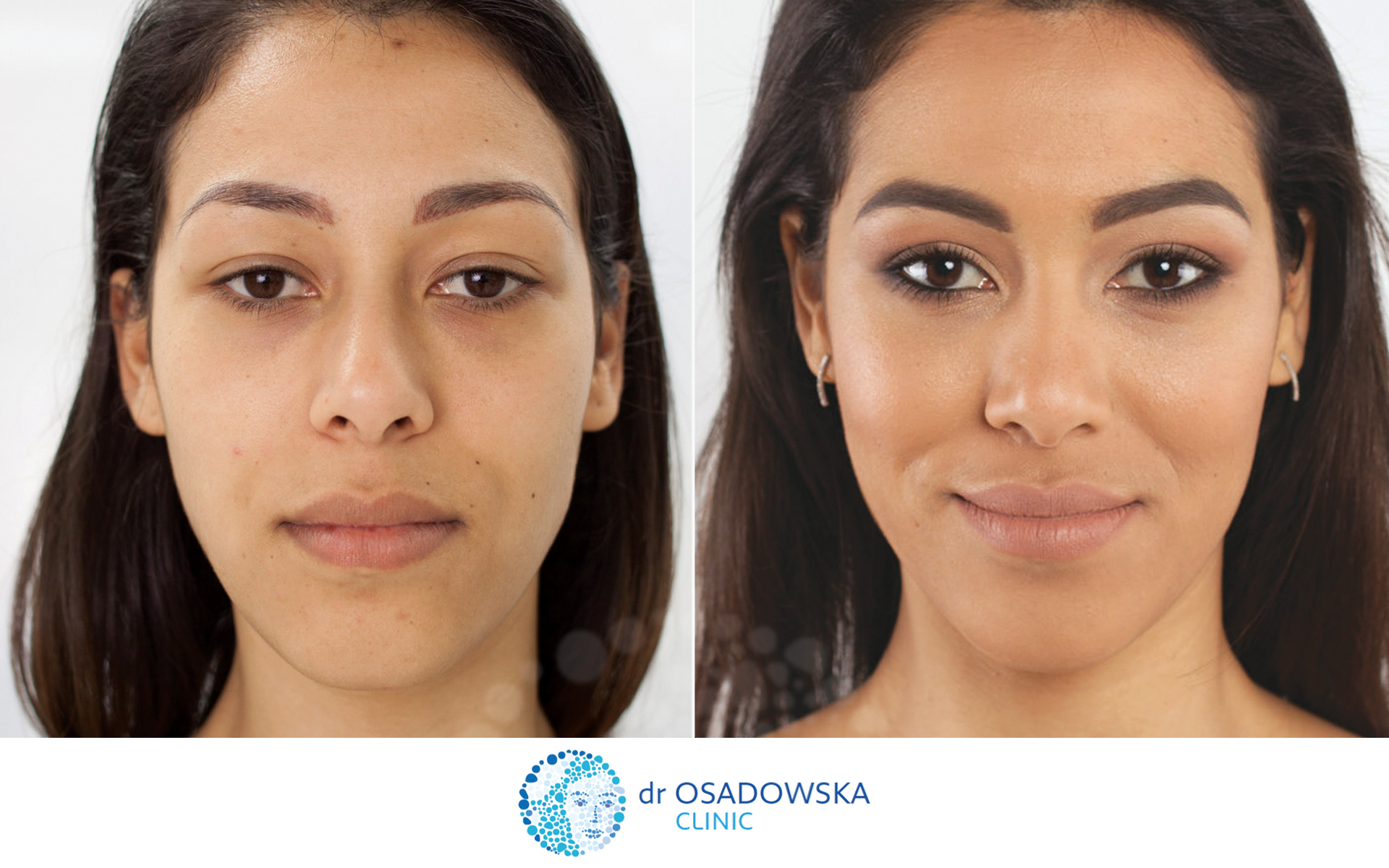 Pictures with upper eyelid laser surgery - blepharoplasty. Photos taken before and 6 months after procedure. 